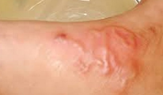 Nhiều trường hợp ở Khánh Hòa bị sán chó, người dân chủ động phòng bệnh