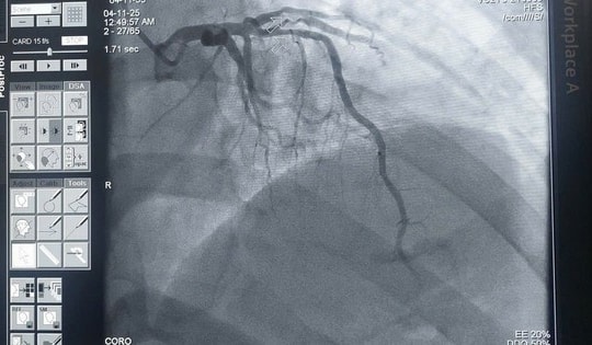Hồi sinh sự sống cho cụ ông 70 tuổi bị nhồi máu cơ tim cấp trong đêm
