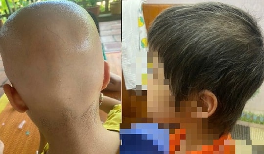Bé gái 7 tuổi rụng hết tóc bất ngờ mọc kín đầu sau một năm