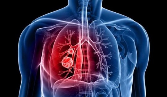 Tình trạng viêm có thể gây khởi phát ung thư phổi ở giai đoạn sớm