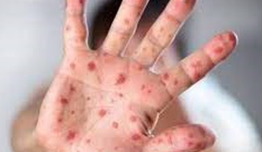 Cảnh giác với nguy cơ bệnh sởi 'trở lại toàn cầu'