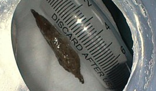 Ăn cháo yến, người phụ nữ bất ngờ bị hạt táo đỏ đâm thủng thành dạ dày