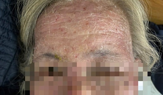 Tưởng có 'sâu bò', người phụ nữ tự điều trị bằng thuốc lá, suýt nguy kịch