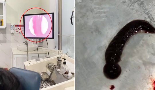 Hãi hùng con đỉa 6cm sống trong mũi cụ bà suốt 3 tuần