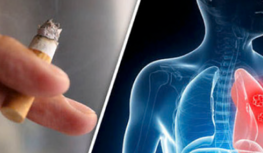 9 ca ung thư phổi đầu tiên từ nghiên cứu mới ở Singapore đều là người không hút thuốc