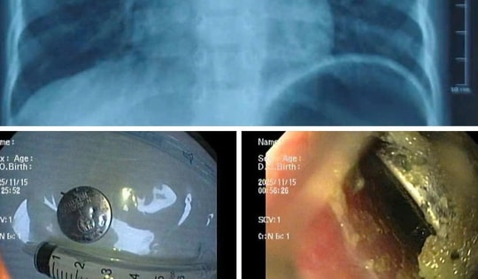 Bé trai ở Hải Phòng bị loét thực quản nặng vì nuốt pin cúc áo