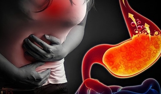 Có nên dùng men vi sinh giảm chứng trào ngược axit dạ dày?