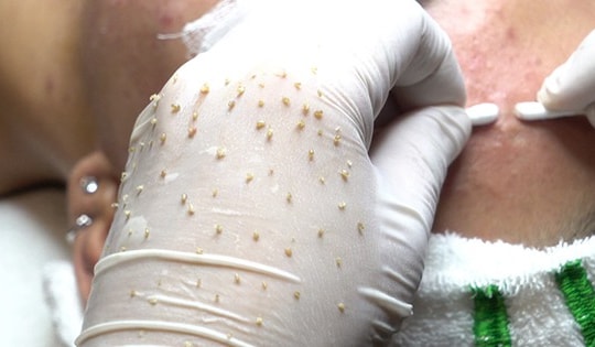 Nỗi đau không thể ngờ sau khi nhiễm H từ một lần làm đẹp tại spa