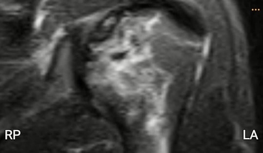 Thợ lặn biển hơn 20 năm bị hoại tử xương cánh tay, xương đùi