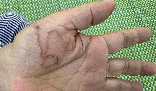 Bị nhiễm ký sinh trùng cần đi khám và điều trị ở đâu?