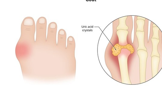 Thiếu vitamin D có thể gây tăng axit uric