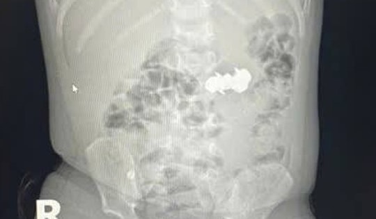 Bé trai nuốt 4 viên đinh nam châm đầu nhọn nguy hiểm
