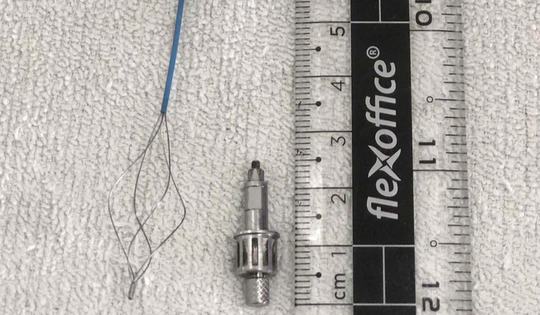 Ho kéo dài sau khi làm răng, người đàn ông phát hiện dụng cụ nha khoa trong phế quản