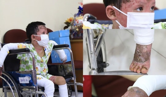 Bệnh nhi bỏng 65% vụ phóng hỏa ở Gia Lai hồi phục ngoạn mục sau 38 ngày điều trị