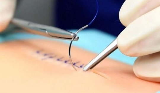 Đột phá phẫu thuật an toàn nhờ nút thắt 'lập trình sẵn'