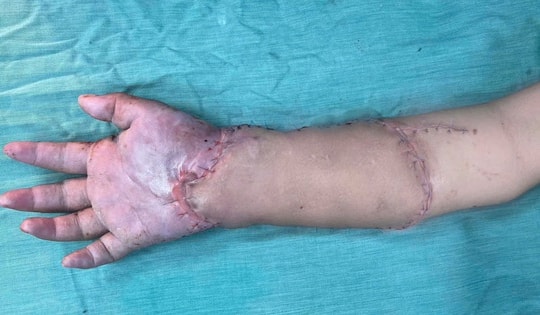 Bác sĩ Võ Thái Trung, BVĐK Bình Dương kể về ca ghép tạm bàn tay vào chân hiếm gặp, cứu mẹ và hai thai nhi