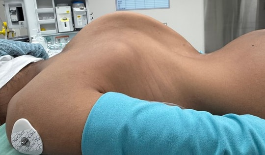 Hành trình nắn lại 'xương sống khủng long' cho hai bé gái