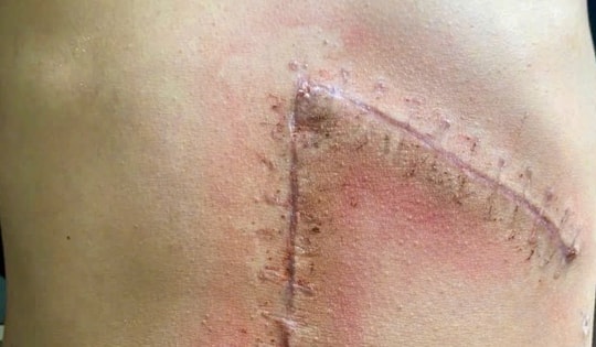 Cứu sống thiếu niên sốc mất máu do vỡ lách độ 5 sau tai nạn giao thông