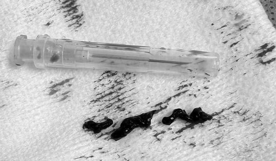 Cụ bà nhiều bệnh nền thoát chết sau cơn đột quỵ trong nhà vệ sinh