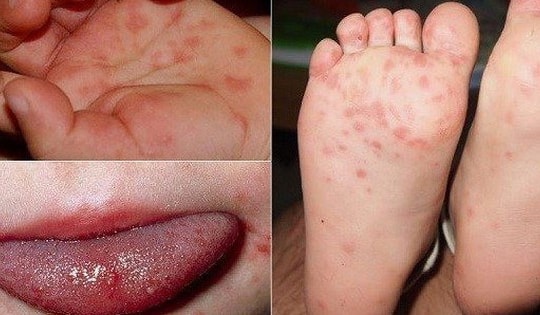 Bệnh tay chân miệng dùng thuốc như thế nào?