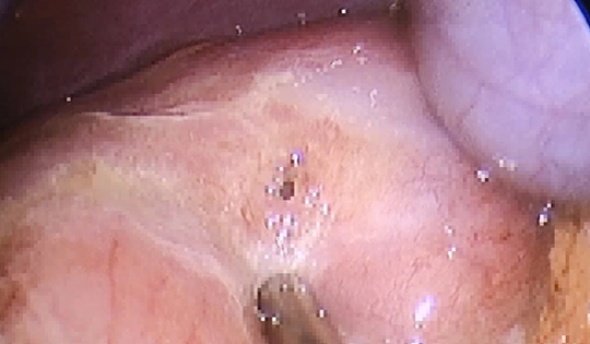 Phẫu thuật cấp cứu bệnh nhi 13 tuổi bị thủng ổ loét dạ dày – tá tràng và lời cảnh tỉnh từ bác sĩ