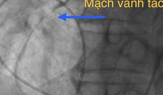 Cứu sống bệnh nhân 70 tuổi vì nhầm nhồi máu cơ tim với 'trúng gió'