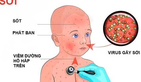 Tự ý dùng kháng sinh khi mắc sởi có thể làm bệnh nặng hơn
