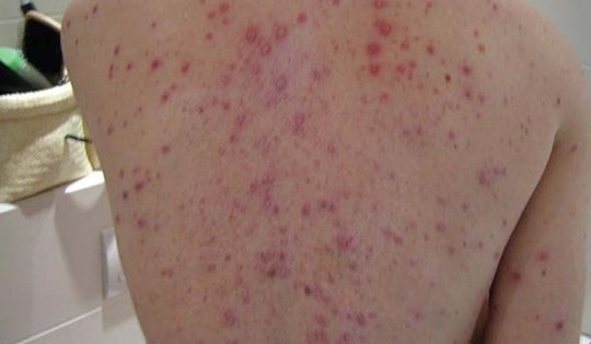 Nguy cơ biến chứng thủy đậu từ việc dùng thuốc sai cách