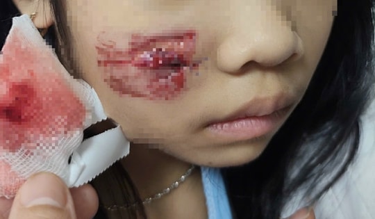 Cháu bé bị khỉ tấn công gây vết thương phức tạp vùng mặt, đầu