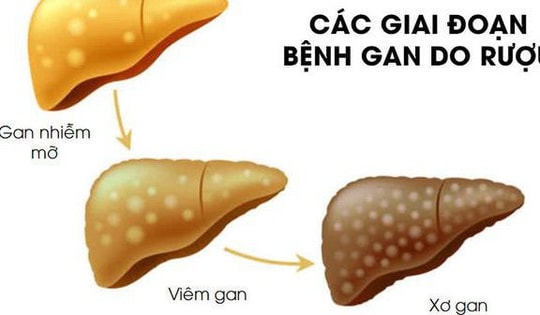 Thói quen âm thầm huỷ hoại lá gan mà đàn ông Việt hay mắc phải