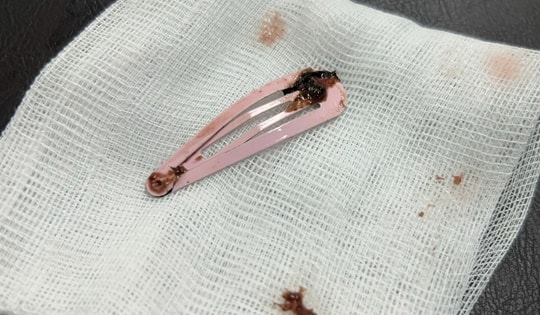 Bé 6 tuổi nhập viện cấp cứu vì nuốt kẹp tóc kim loại