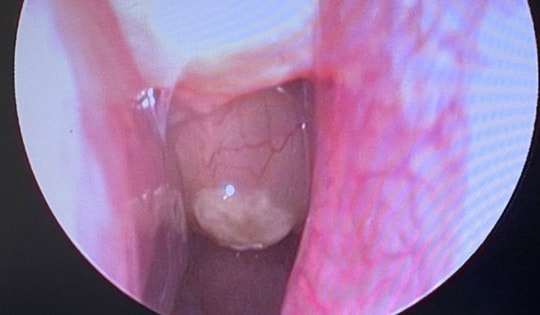 Phẫu thuật thành công cho bệnh nhân polyp mũi hai bên, viêm mũi xoang kèm hàng loạt bệnh lý nền nặng
