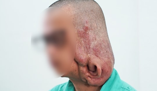 Bóc tách khối u sợi thần kinh khổng lồ gần 1 kg, trả lại diện mạo cho chàng trai trẻ