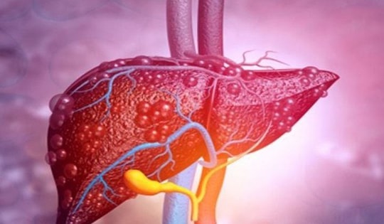 Bệnh gan nhiễm mỡ, hay gặp nhưng nguy hiểm