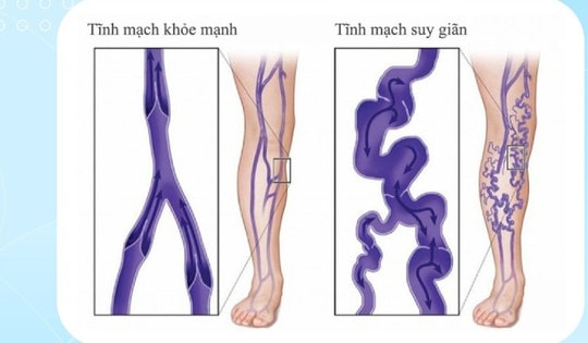 Thuốc và phương pháp điều trị suy tĩnh mạch chi dưới mạn tính