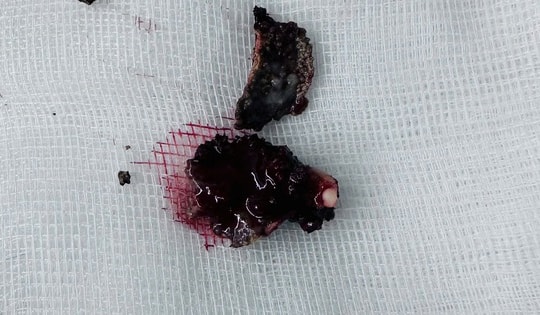 Bác sĩ lấy dị vật vôi hóa tồn tại nhiều năm trong mũi bệnh nhân