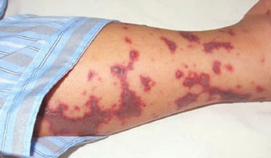 Số ca mắc bệnh do não mô cầu tăng, chuyên gia y tế khuyến cáo gì đến cộng đồng?