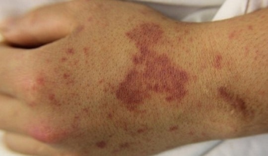 Chuyên gia khuyên gì về căn bệnh truyền nhiễm có thể gây tử vong trong 24h?