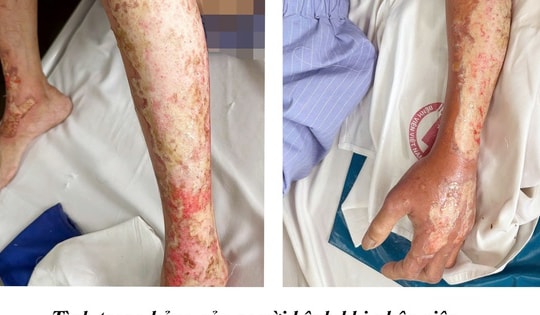 Bỏng nặng khi đốt sofa cũ, người đàn ông vào viện cấp cứu