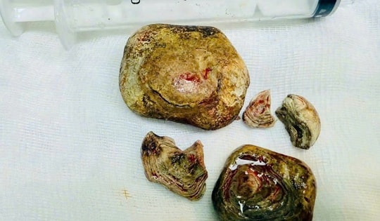 Phẫu thuật khối sỏi bàng quang kích thước lớn cho bệnh nhân mắc nhiều bệnh lý nền