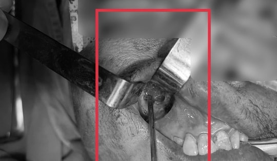 Nấm đen 'ăn' mòn xoang hàm người đàn ông khỏe mạnh