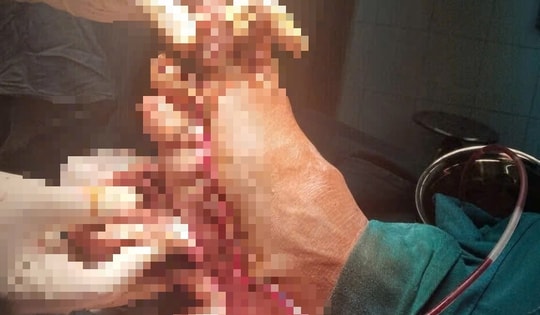 Người đàn ông suýt mất bàn chân vì máy cắt cỏ