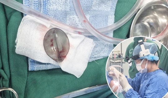 Kịp thời phẫu thuật lấy muỗng nhựa khỏi đường thở bé trai 4 tuổi