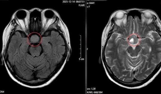 Nhìn mờ kéo dài, người phụ nữ phát hiện u tuyến yên nhờ khám mắt