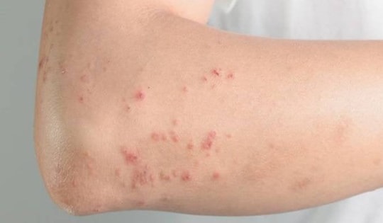 Nhiều trường hợp ở Khánh Hòa bị giun đũa chó mèo, người dân chủ động phòng bệnh