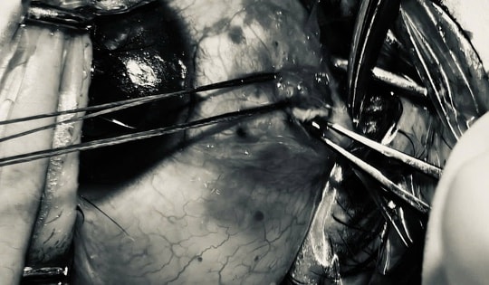 Bảo tồn nhãn cầu cho bệnh nhân bị đinh sắt bắn vào mắt