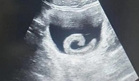 Người đàn ông phải nhập viện cấp cứu vì… đỉa sống trong bàng quang