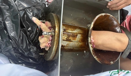 Bị máy xay thịt cuốn tay, nam công nhân bị cắt cụt tới 1/3 trên cẳng tay