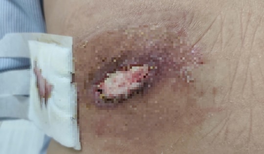 Người phụ nữ bị hoại tử lưng vì điều trị mụn nhọt theo phương pháp truyền miệng