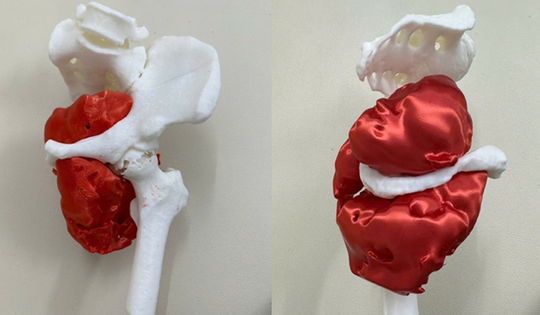 Cứu sống bệnh nhân ung thư hiếm gặp bằng phẫu thuật tháo nửa khung chậu